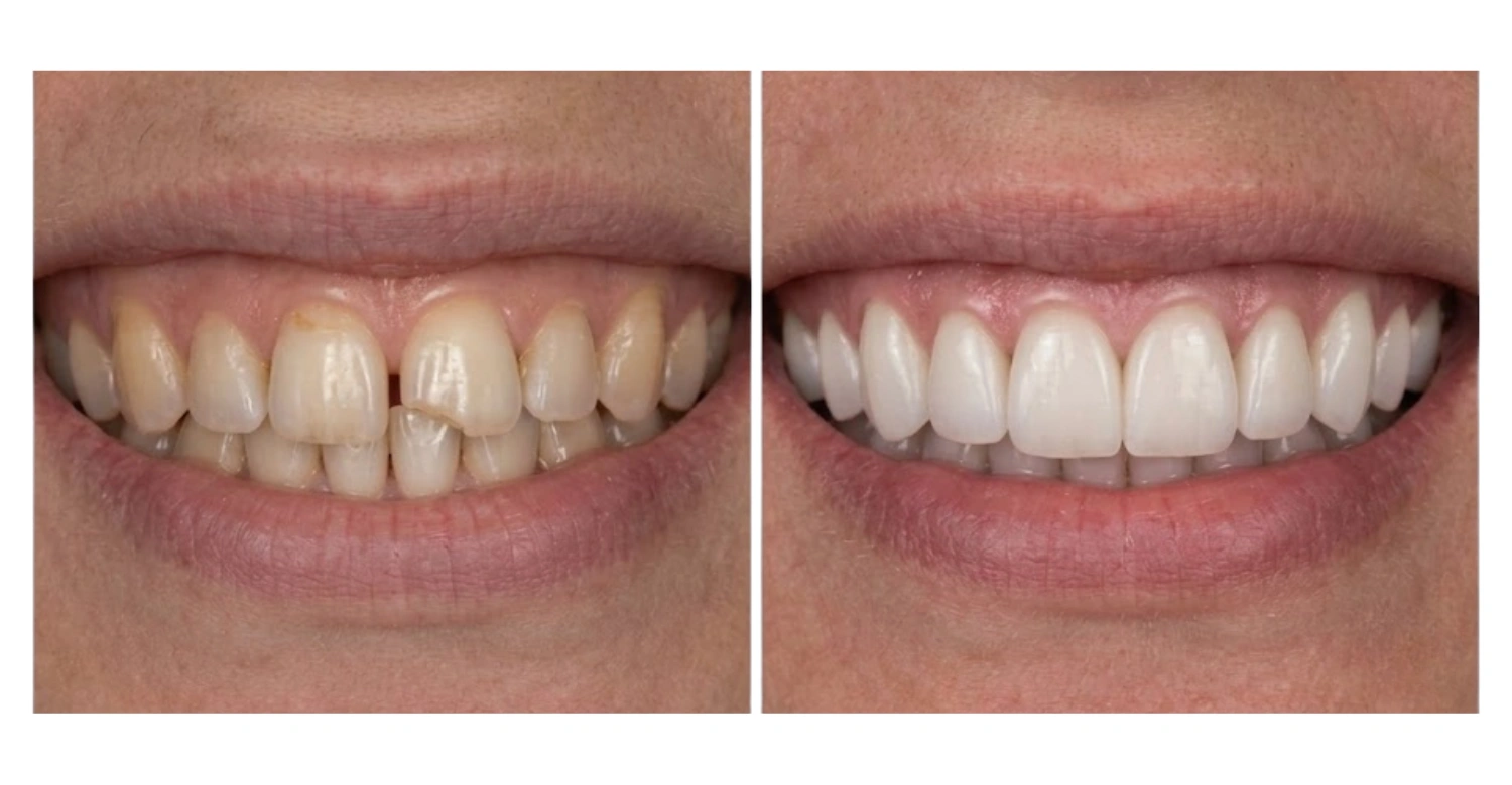 Veneers cost Inblog